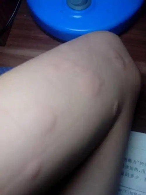 老人说是风疙瘩,一起来一片一片的.这是过敏吗,用不用去医院做做检查?