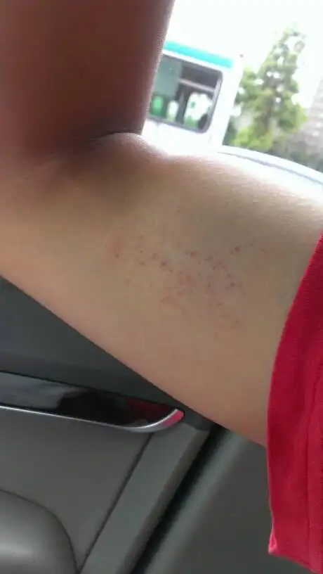 区张格庄医院 答: 你好,你提供的情况是皮肤毛囊处的出血点的情况的