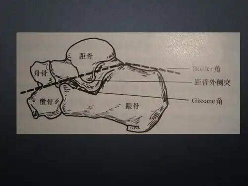 无忧文档 所有分类 跟骨骨折ppt课件 第4页 (共25