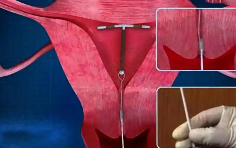 女人上环副作用大,避孕环的5大坏处不可忽视