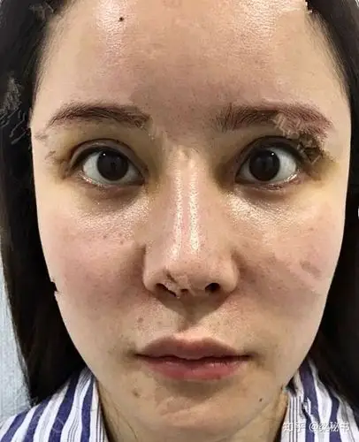 全切双眼皮失败能修复好吗两码事别拿埋线举例混为一谈