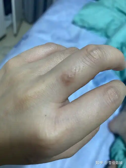 液氮冷冻治疗跖疣过程记录