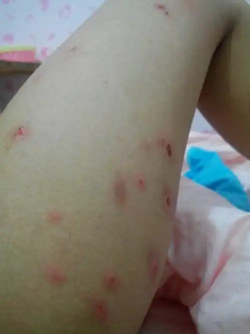 预防宝宝被虫咬皮炎图片