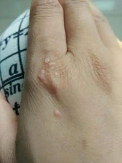 手上轻微扁平疣图片