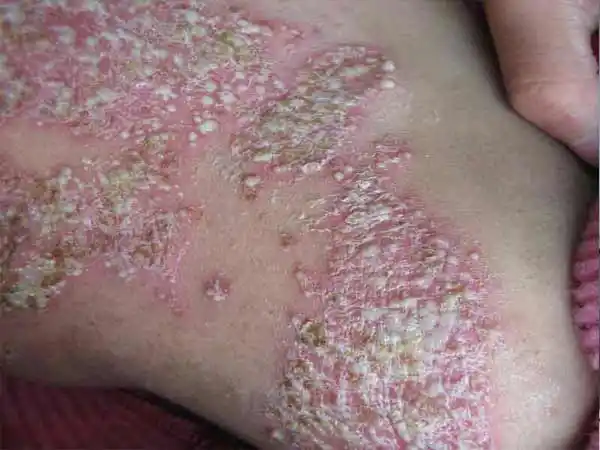 脓疱型银屑病的特点