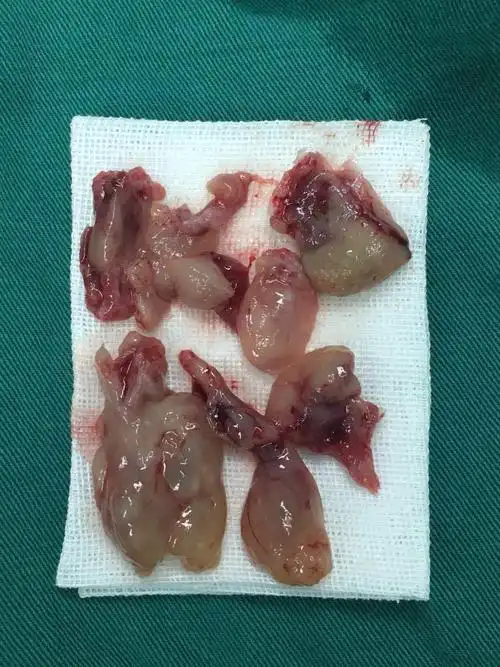 鼻息肉(鼻孔塞满了) - 好大夫在线