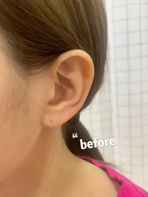 玻尿酸耳垂