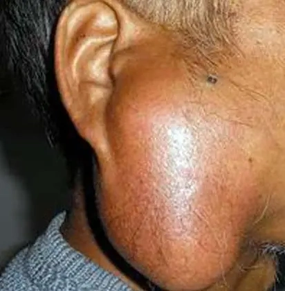 耳朵前长肿块你看对医生了吗