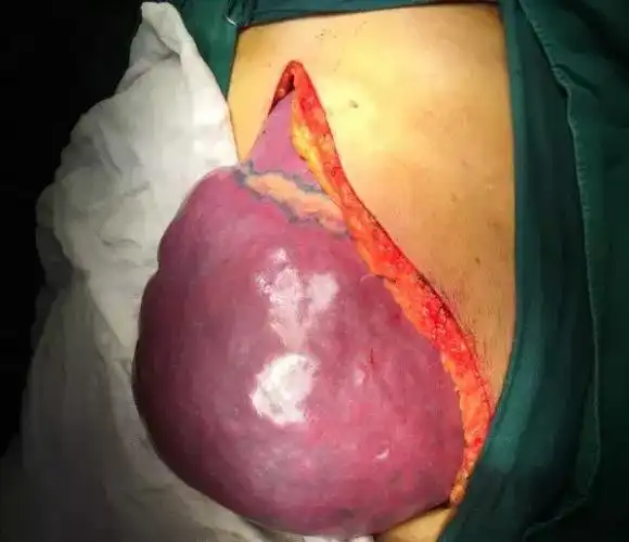 手术之前先了解它的术后危害