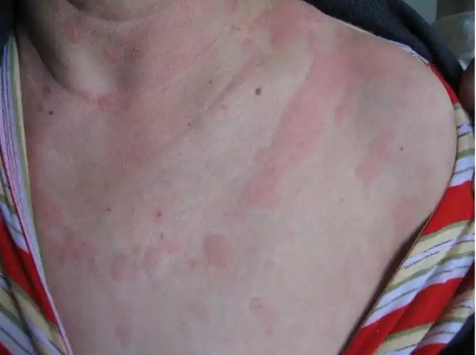 荨麻疹症状图片真实案例实拍