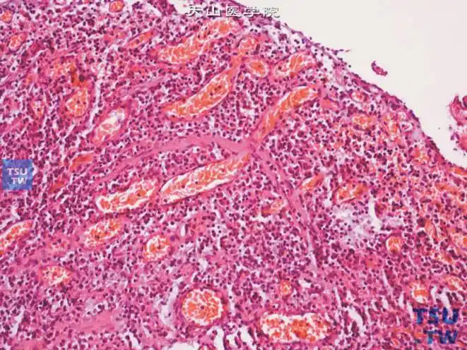 尿道肉阜,肉芽组织型,被覆上皮较薄或脱落,间质可见大量炎性肉芽组织