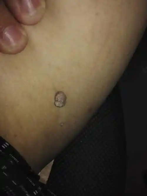 大腿内侧长一个肉疙瘩,不知道是什么.一年多了吧.不疼不痒,没