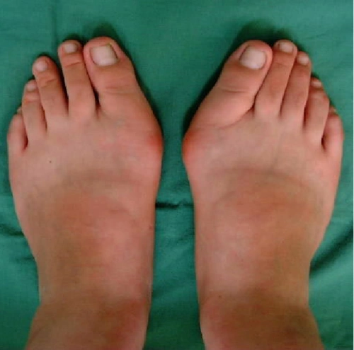 ii度:外翻的脚拇趾与其它的脚趾发生挤压.