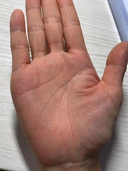 手汗症治疗手术是唯一有效的办法