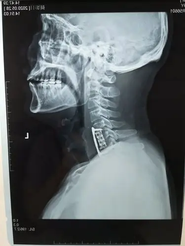 保靖县中医院骨伤科完成首例脊髓型颈椎病手术 - 美篇