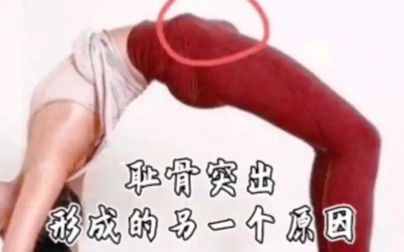 耻骨突出形成的另一个原因