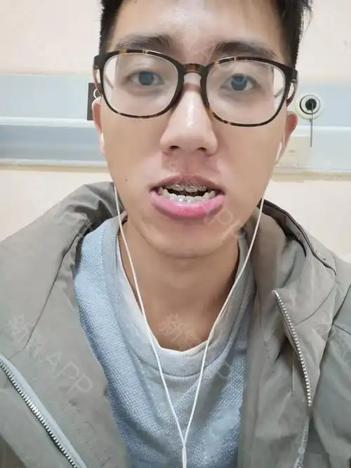 从初中发现自己地包天,成了自卑的心结,就多方面了解了正颌手术的全