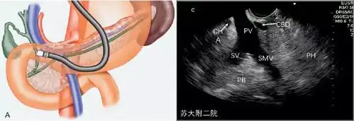 门静脉球部探查(pv:门静脉,sv:脾静脉 smv:肠系膜上静脉,cbd:胆总