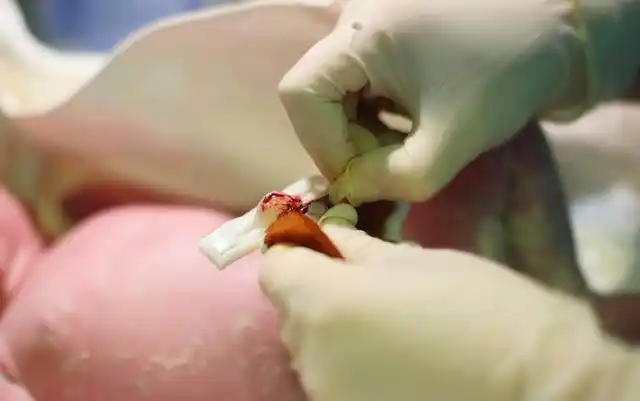 4,产后观察和取出胎盘宝宝的分娩之旅结束了,但宝妈的事可还没完,还要