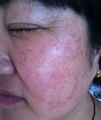 激光祛斑后反黑图片6