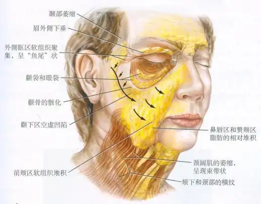 脂肪丰面部是否会任意流动?术后是否会下垂?脂肪填充到面部,有的朋友