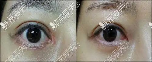 内眼角括号疤痕非手术去疤前后对比照