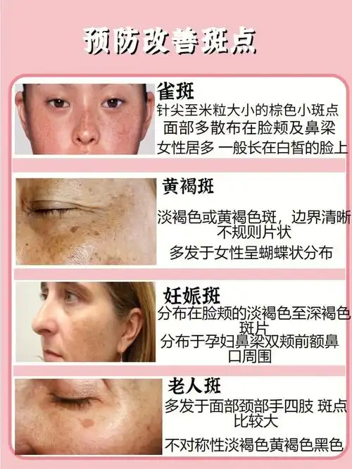 斑点女孩请进60美白淡斑抓紧看过来