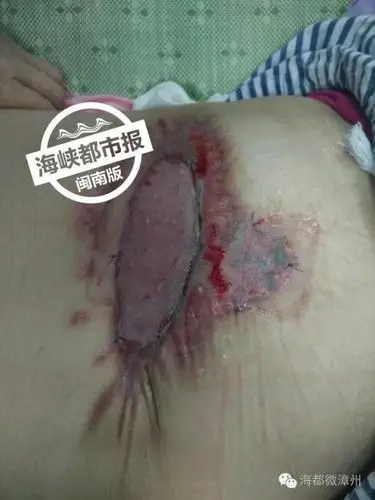 02  市民被毒虫叮咬,怎么办?