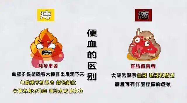 便血因为痔疮30小伙却确诊直肠癌出现这些情况要警惕