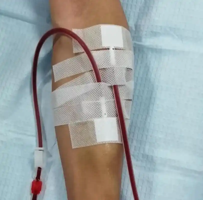 打通血透患者生命线闭塞三月后成功再开通