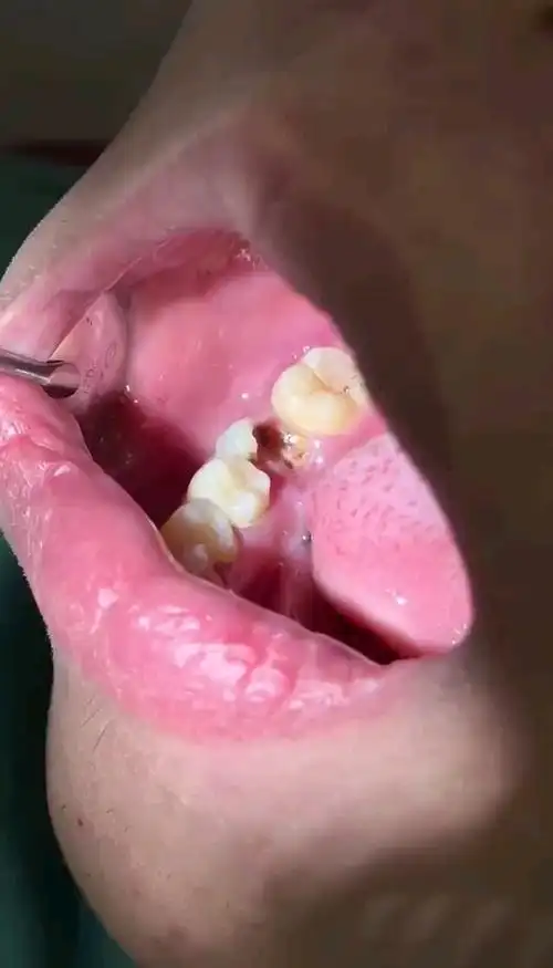 烂的只剩牙根了!