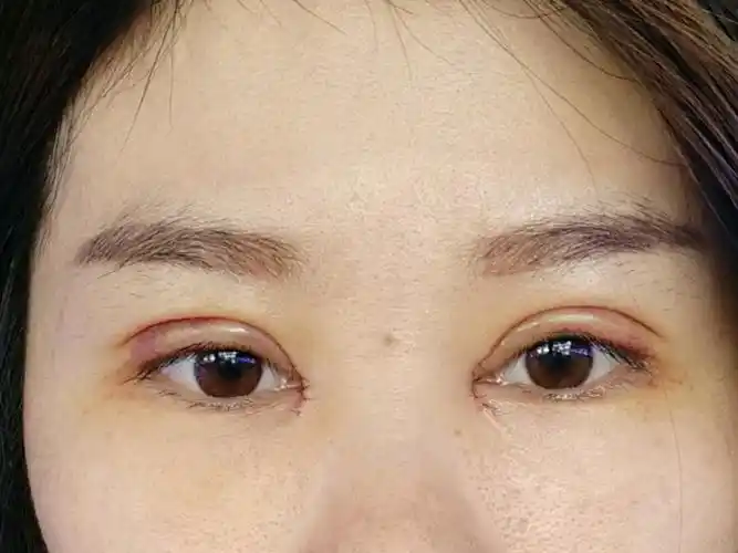 全切双眼皮加开眼角,加上睑提肌,今天第5天了,想问_圈子-新氧美容整形