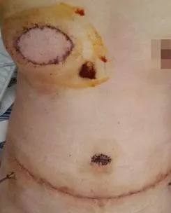 暨大附一院成功进行i期乳房自体组织重建术