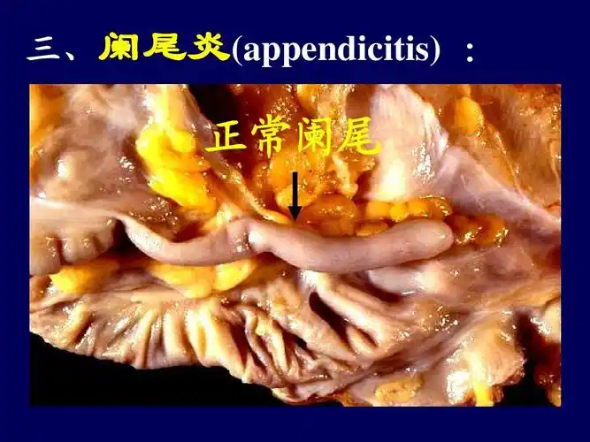 正常阑尾