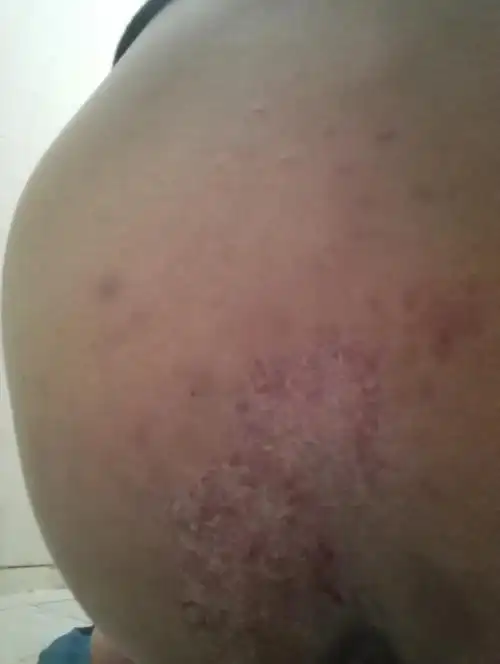 屁股上面一点长了这样的东西不知道是什么用手挠有点痒痒的