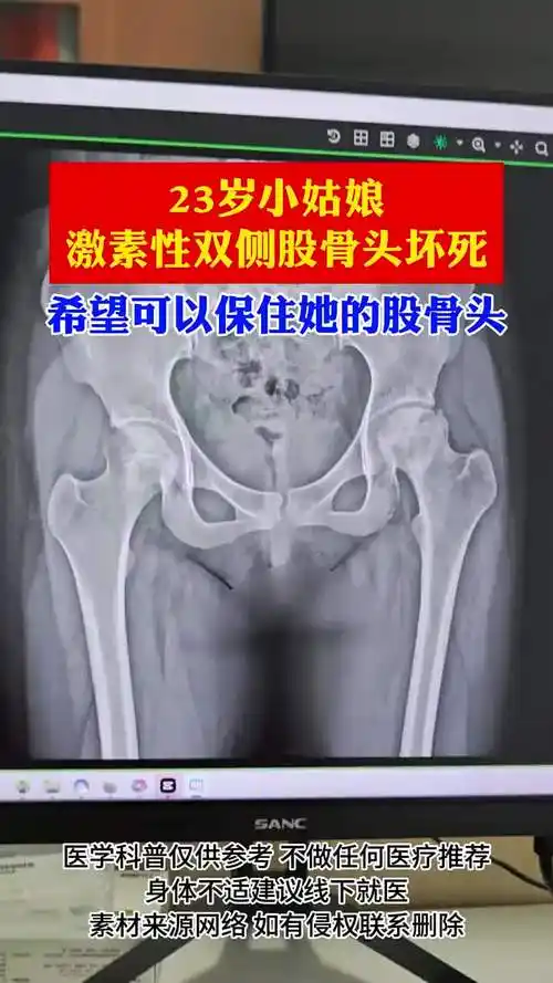 23岁小姑娘双侧激素性股骨头坏死