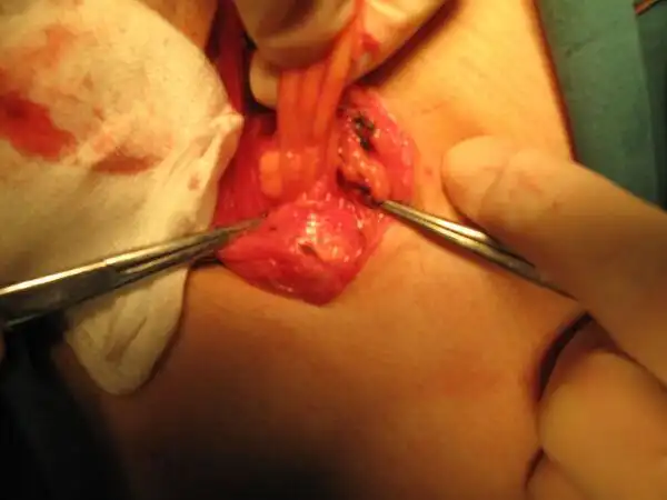 根治性睾丸切除术