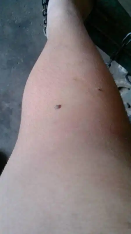 如图腿上两个扁平疣(瘊子)用力动它会很痛,是怎么回事