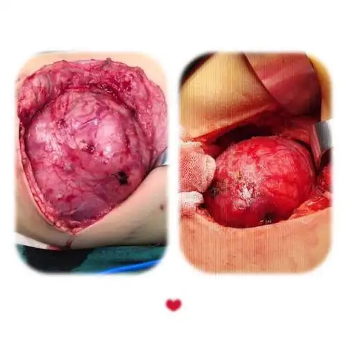 肾母细胞瘤与神经母细胞瘤?