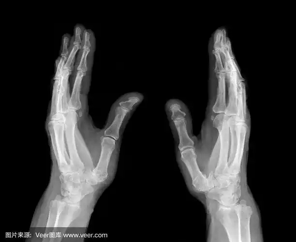x光照片-手掌