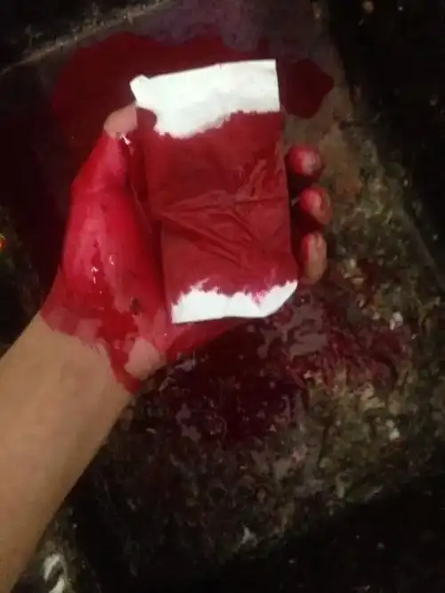 人吐血是怎么回事 癌症病人吐血是怎么回事