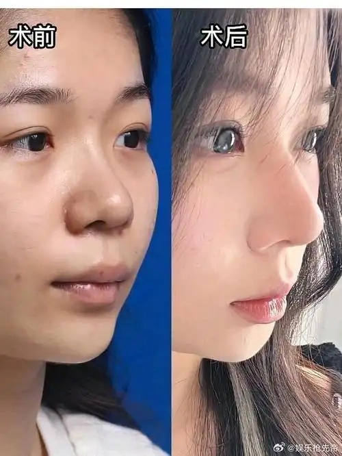 做过一次鼻子,因为大白审美和技术的问题变成了蒜头鼻,鼻梁细,鼻头大