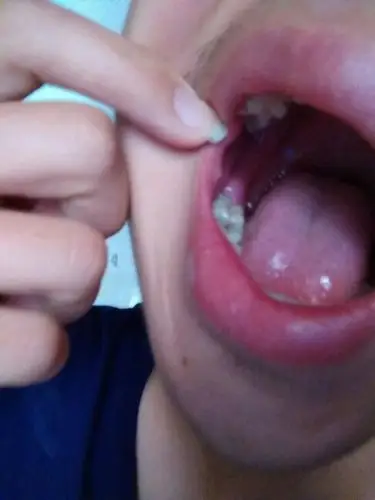 最里面那块肉肿了一个小包.也不知道是不是长智齿了.怎么办