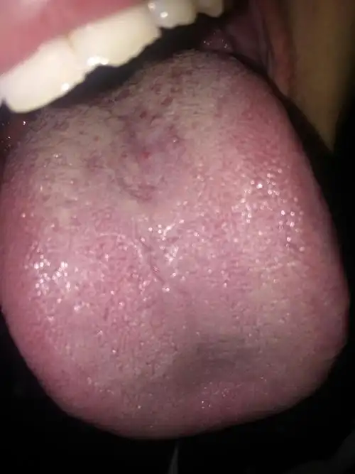 请问我这个舌头上红点是什么