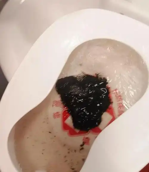 典型的咖啡色呕吐物,柏油样便