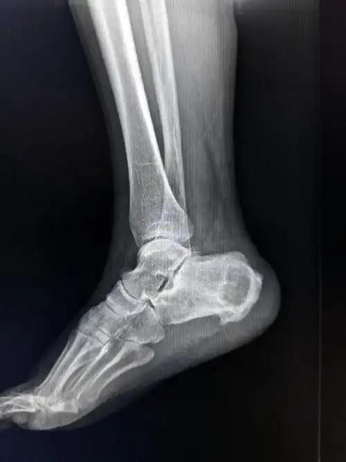 其它 跟骨脓肿 写美篇吉林省洮南市中医医院