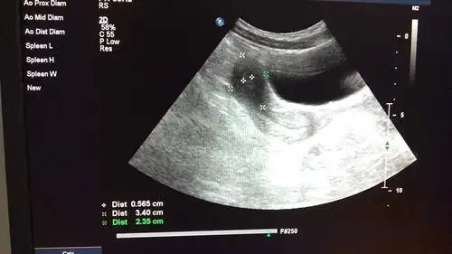 这是幼稚子宫吗?对生育有影响吗?