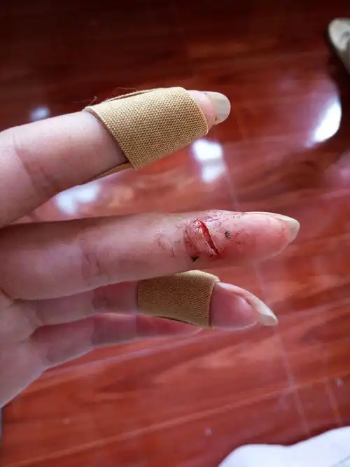 刀割伤后,如果不出现感染,一般7到10天是可以愈合的,建议每天消毒伤口