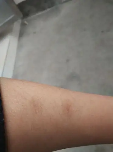 去年烫了两个烟疤 不知还能不当兵 求大神解答