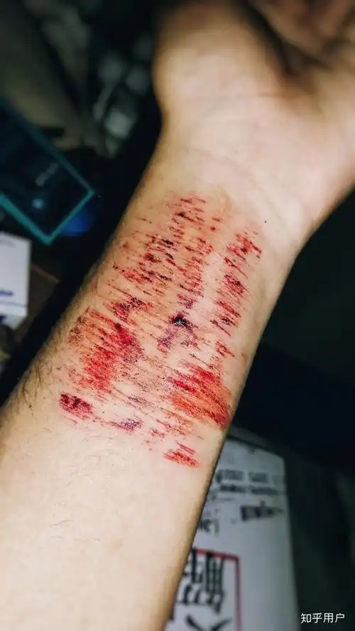 你的抑郁症经历是什么?